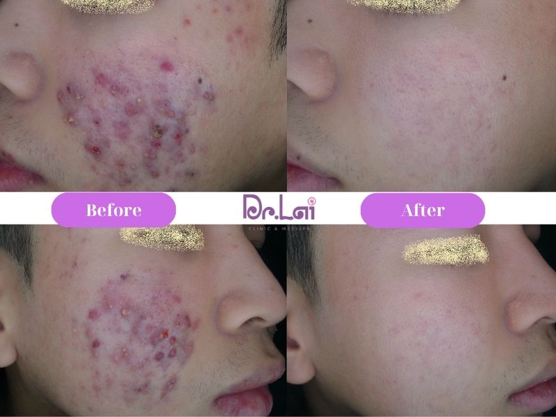 Điều trị mụn bao lâu thì khỏi? Lộ trình chuẩn Y khoa