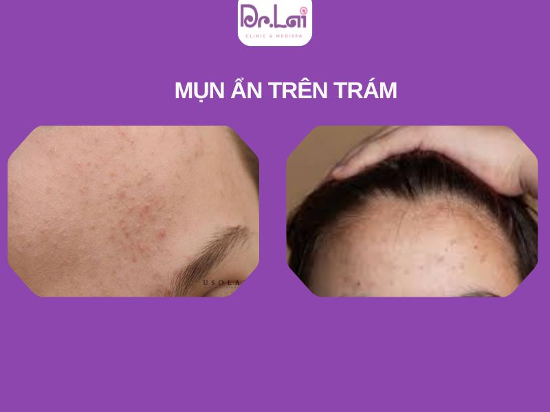 Nhận biết mụn ẩn trên trán