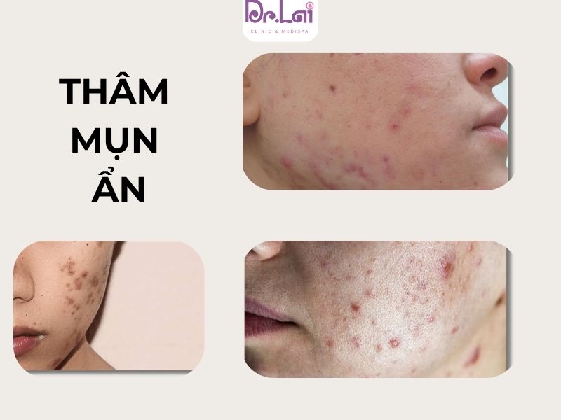 Nguyên nhân gây thâm mụn ẩn