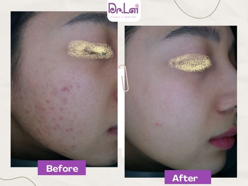Hình ảnh thực tế điều trị da tại Dr. Lai