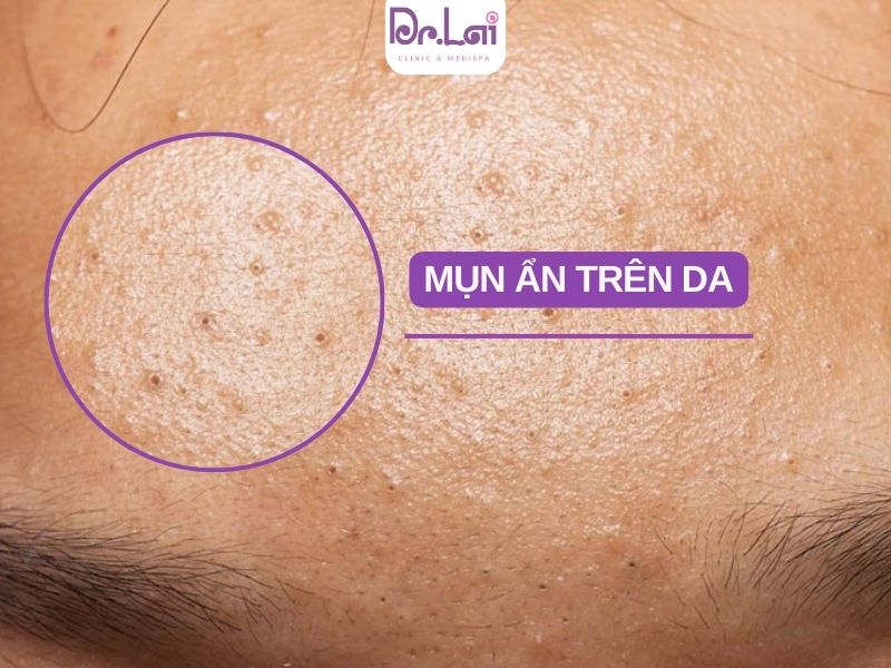 Sử dụng hoạt chất hỗ trợ mờ thâm