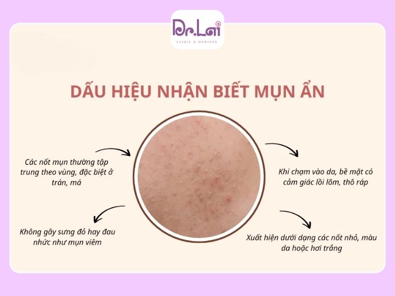 Trị thâm mụn ẩn có tự hết không?